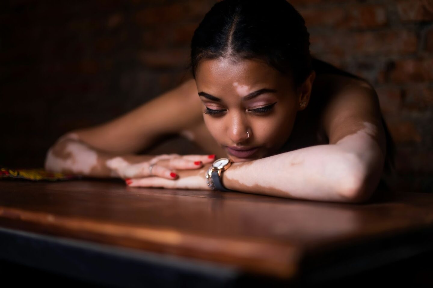 A young woman with vitiligo rests her head on her folded arms at a table, appearing thoughtful and introspective. The warm lighting and calm atmosphere evoke a sense of vulnerability and reflection about body image and self-acceptance.
